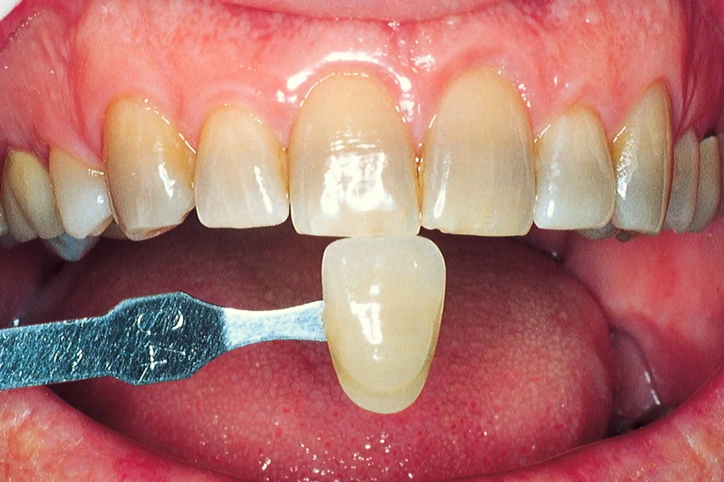 Tooth shade match before crown in Phoenix, AZ | 24th Street Dental Biltmore
