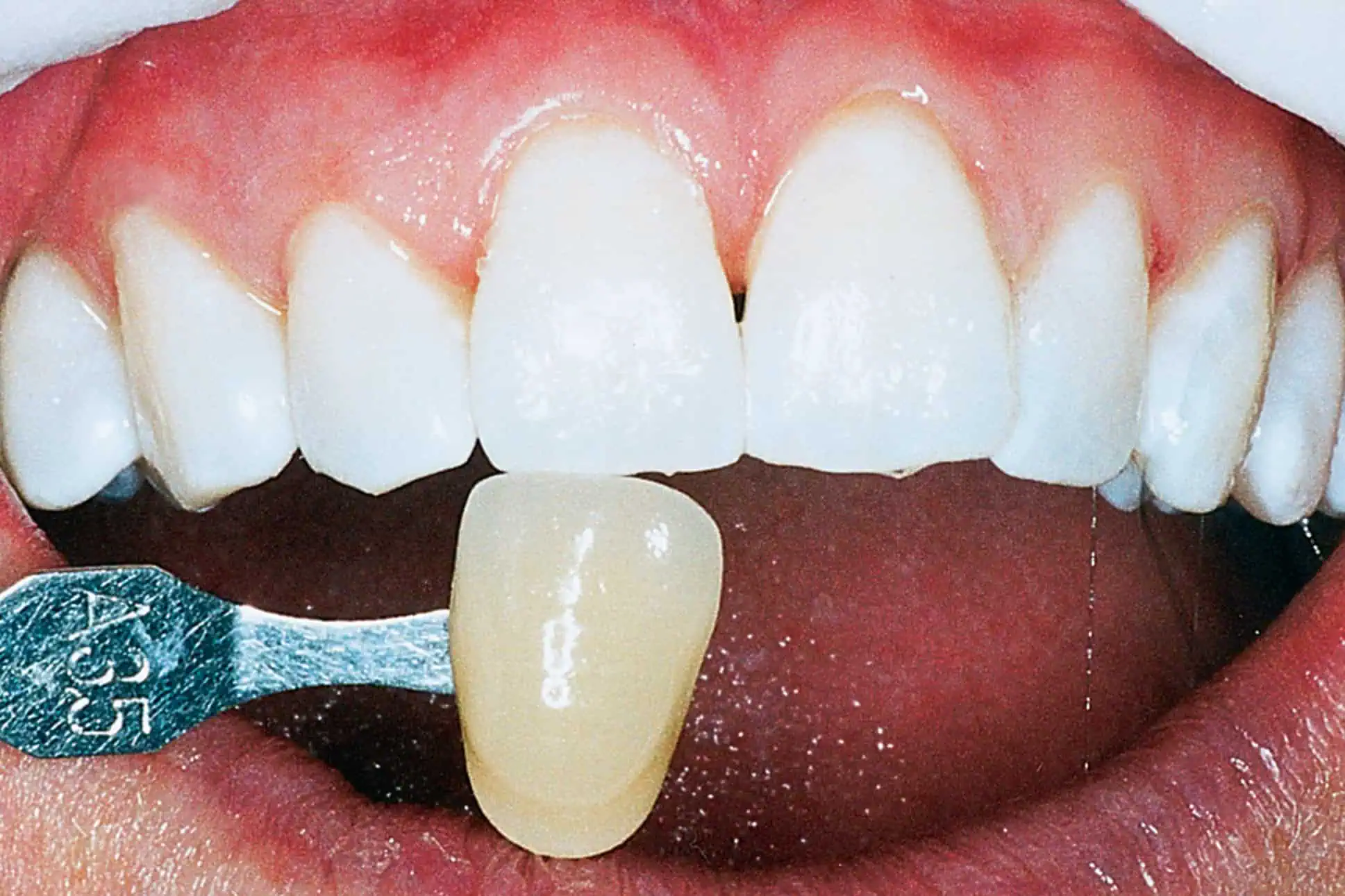 Tooth shade match after crown in Phoenix, AZ | 24th Street Dental Biltmore