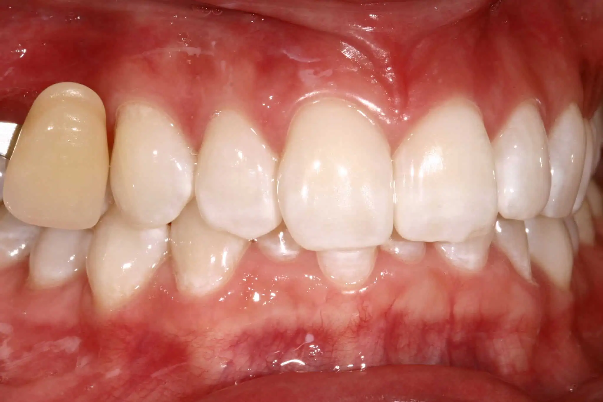 Tooth shade match after crown in Phoenix, AZ | 24th Street Dental Biltmore