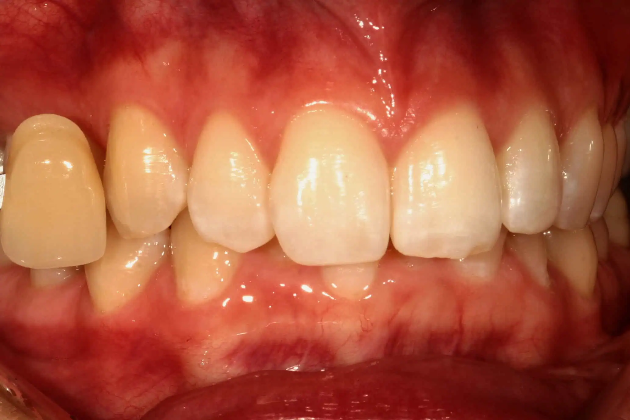 Tooth shade match before crown in Phoenix, AZ | 24th Street Dental Biltmore