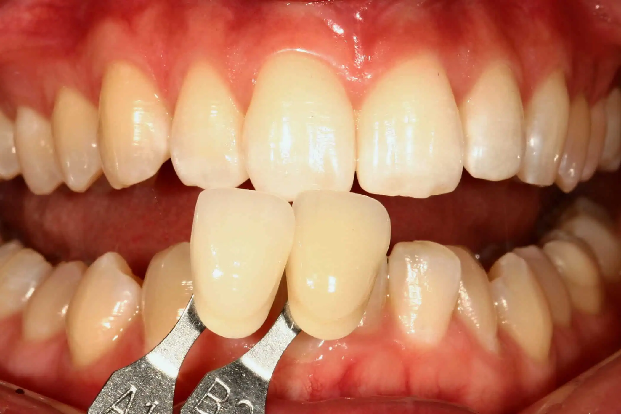 Tooth shade match before crown in Phoenix, AZ | 24th Street Dental Biltmore