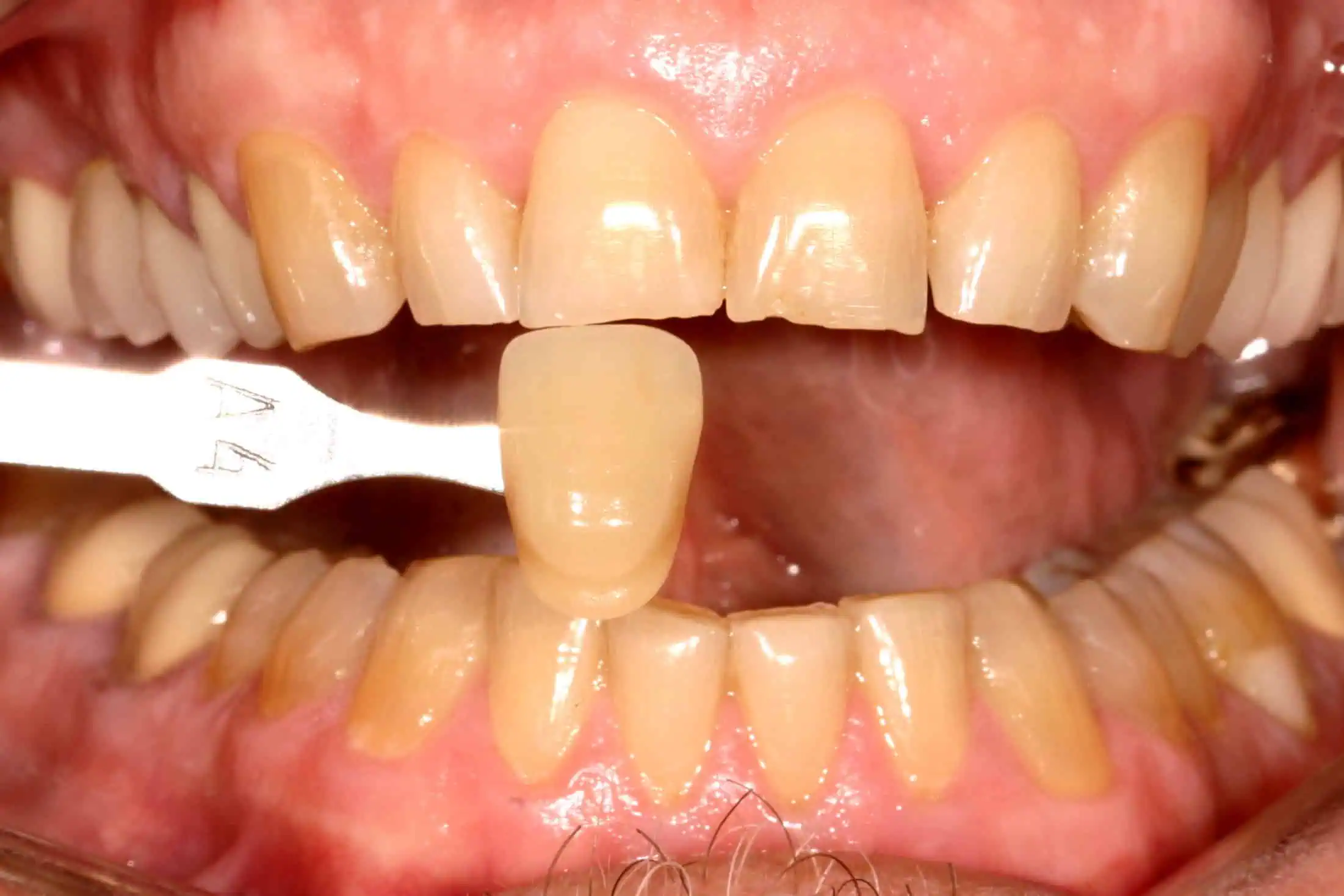 Tooth shade match before crown in Phoenix, AZ | 24th Street Dental Biltmore