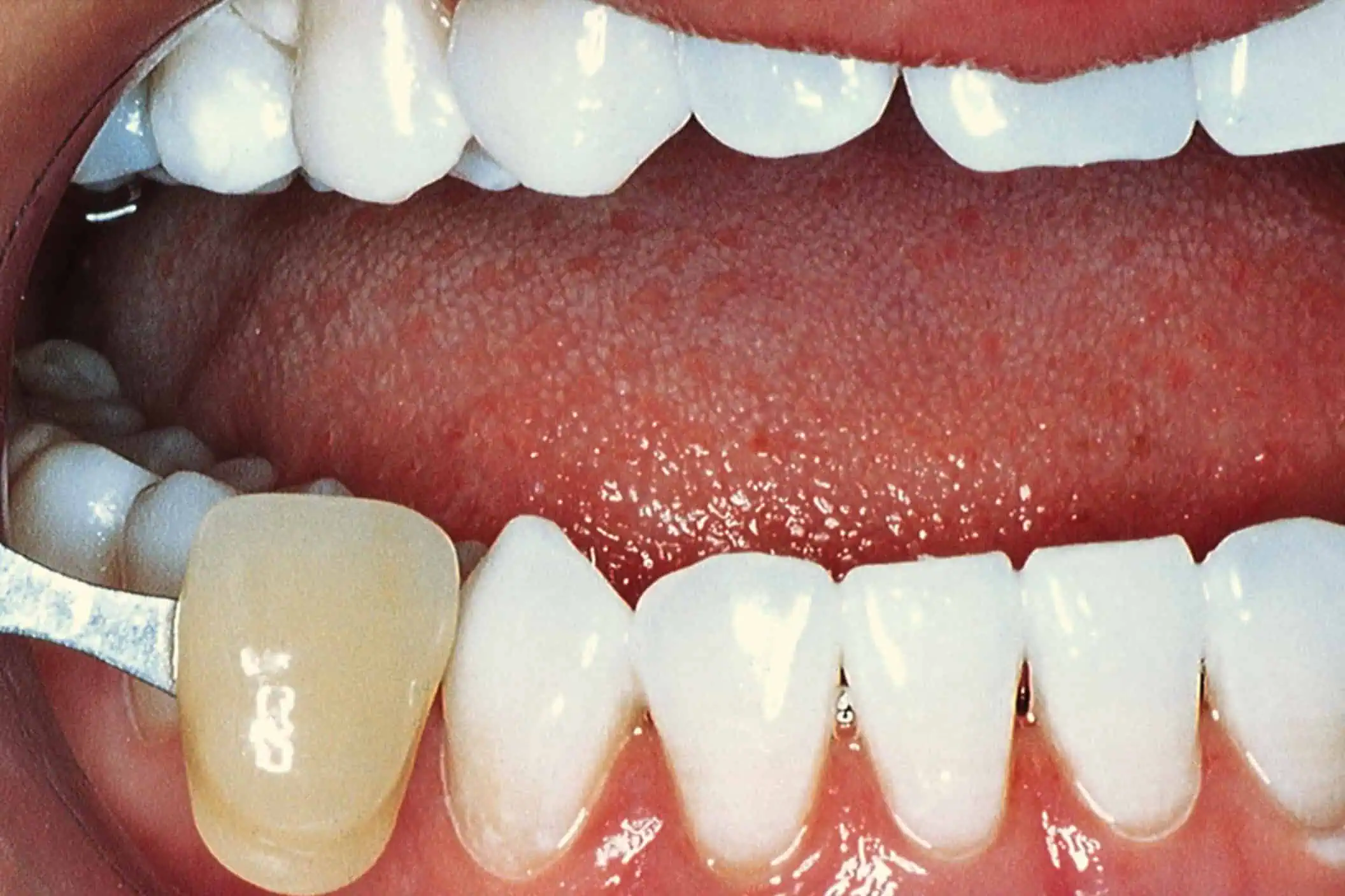 Tooth shade match crown in Phoenix, AZ | 24th Street Dental Biltmore