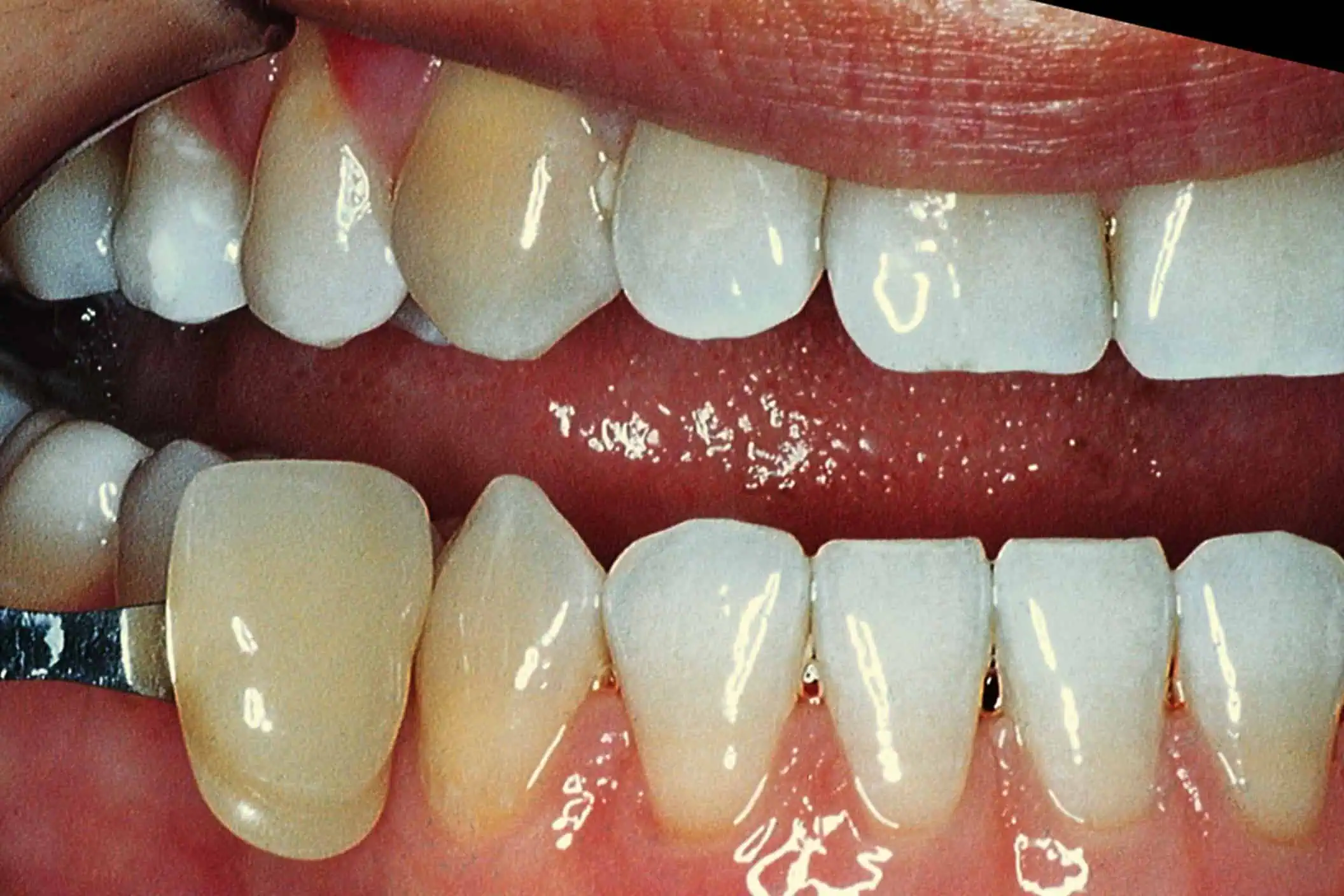 Tooth shade match before crown in Phoenix, AZ | 24th Street Dental Biltmore