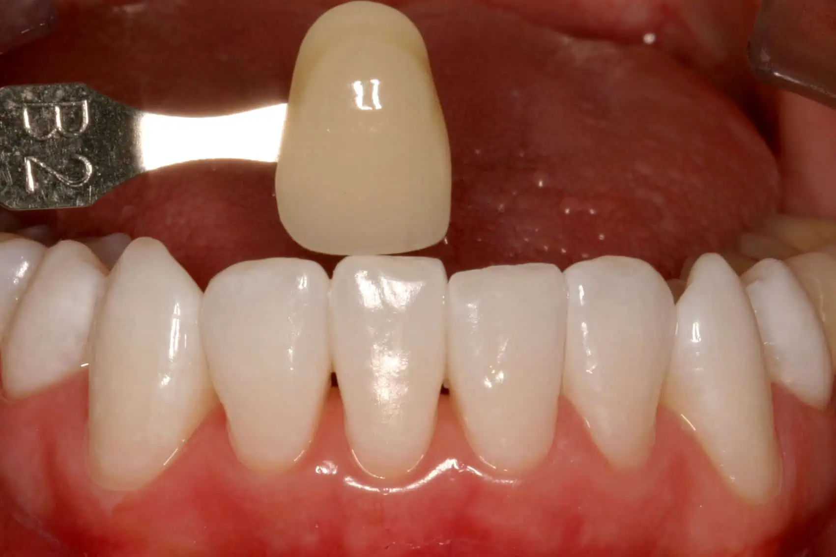 Tooth shade match crown in Phoenix, AZ | 24th Street Dental Biltmore