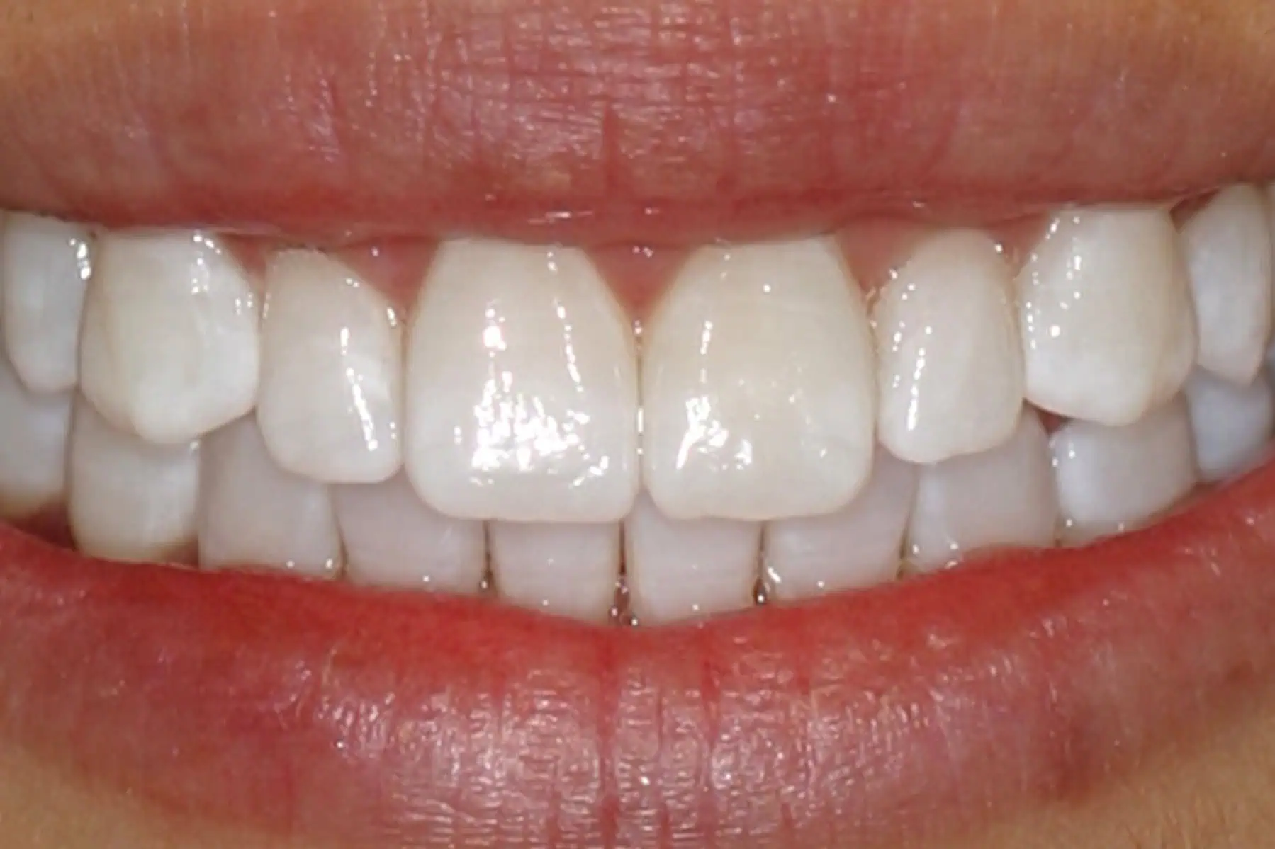 Natural teeth with yellow stains in Phoenix, AZ | 24th Street Dental Biltmore
