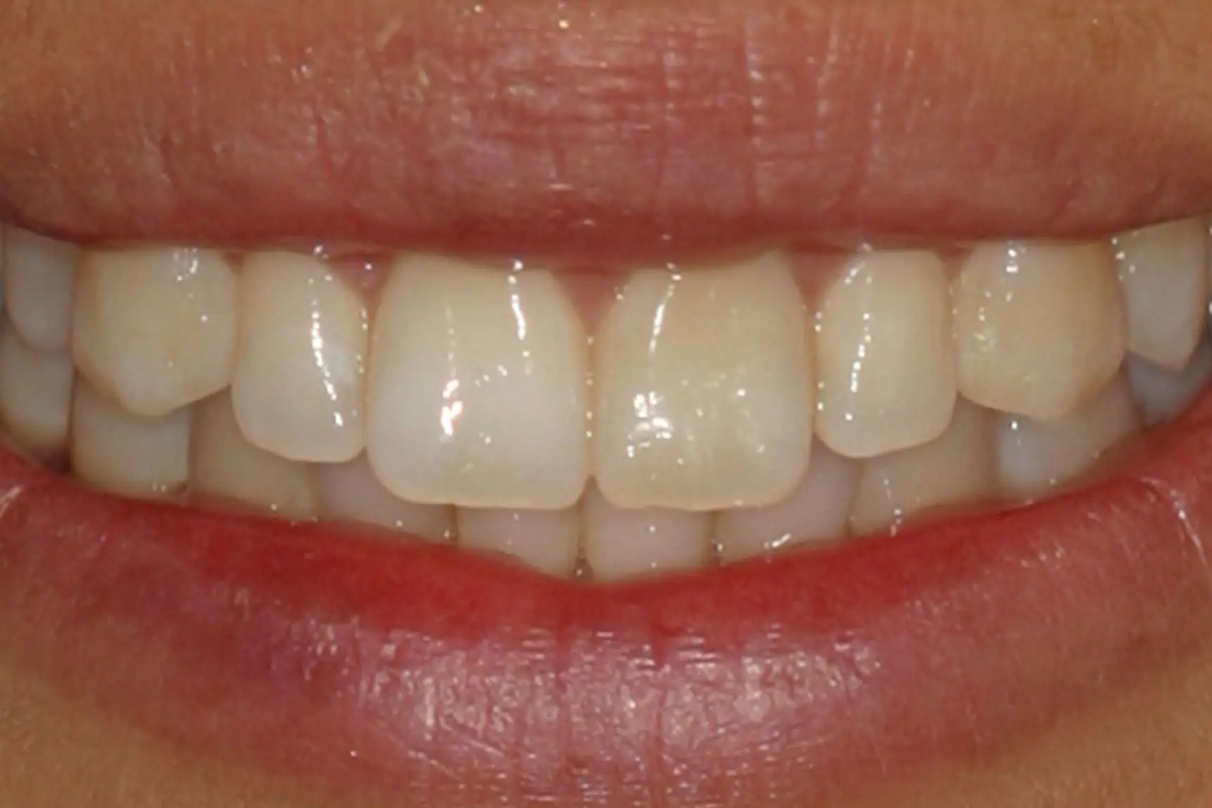 Yellow stains teeth in Phoenix, AZ | 24th Street Dental Biltmore