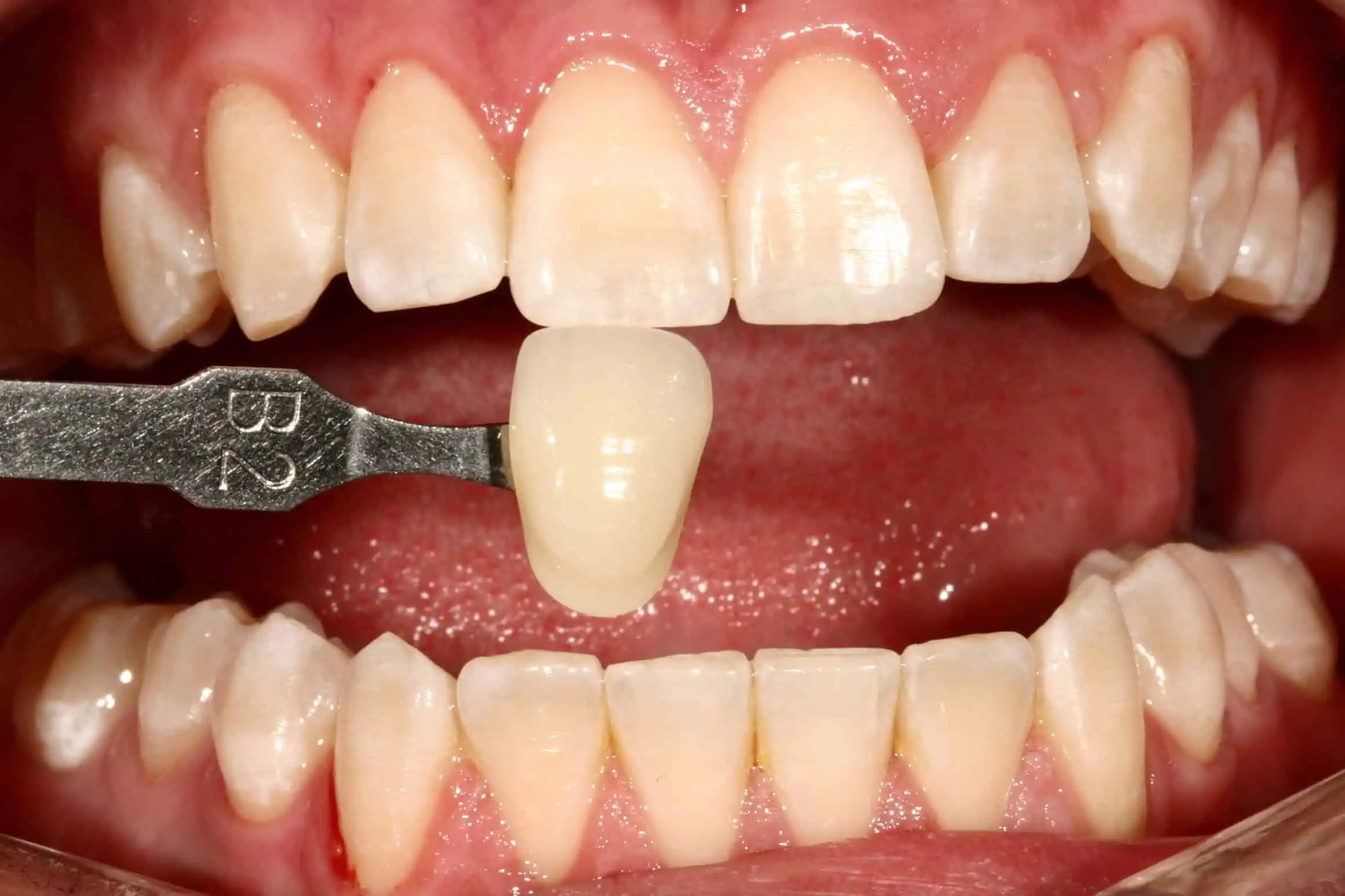 Tooth shade match before crown in Phoenix, AZ | 24th Street Dental Biltmore