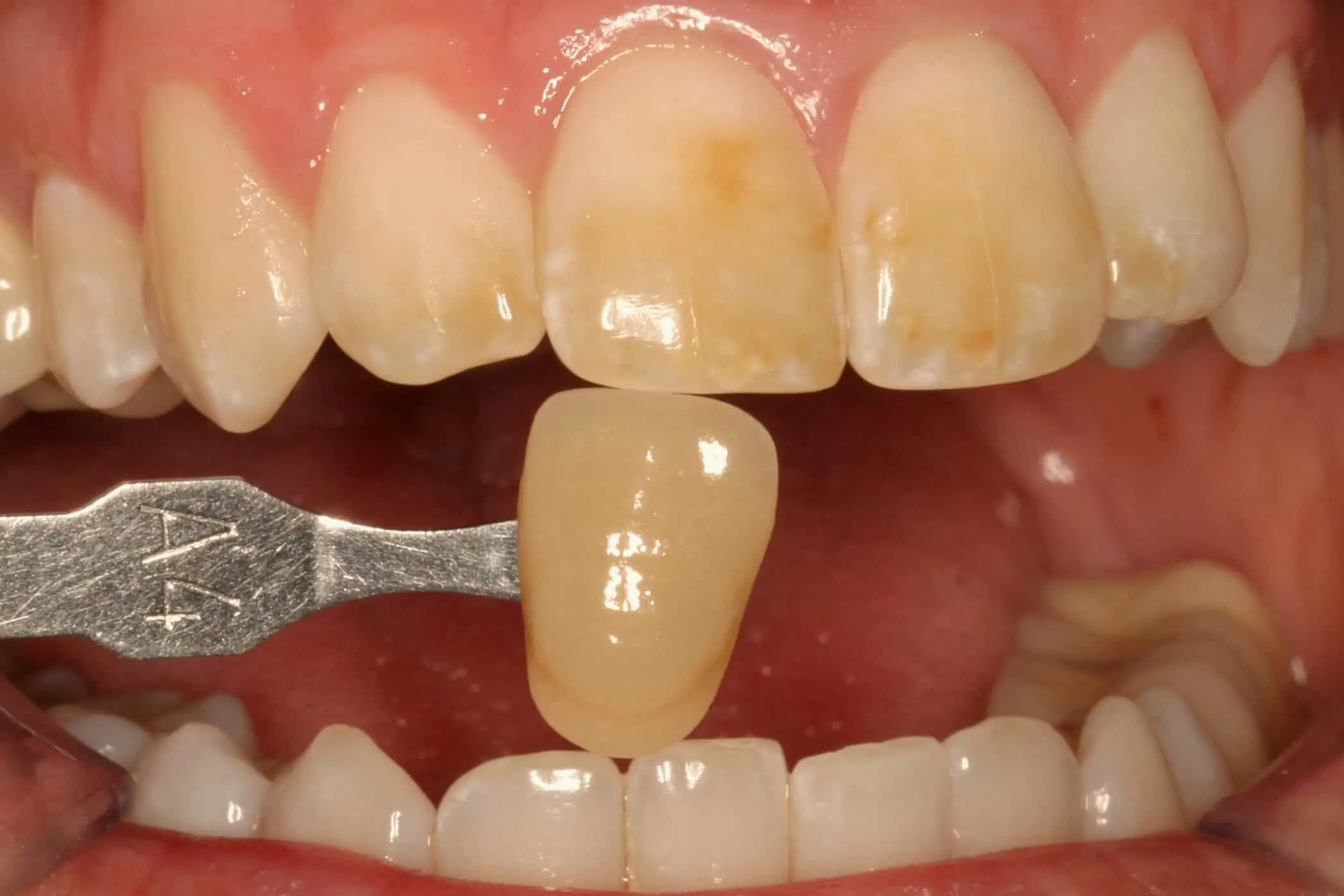 Tooth shade match before crown in Phoenix, AZ | 24th Street Dental Biltmore