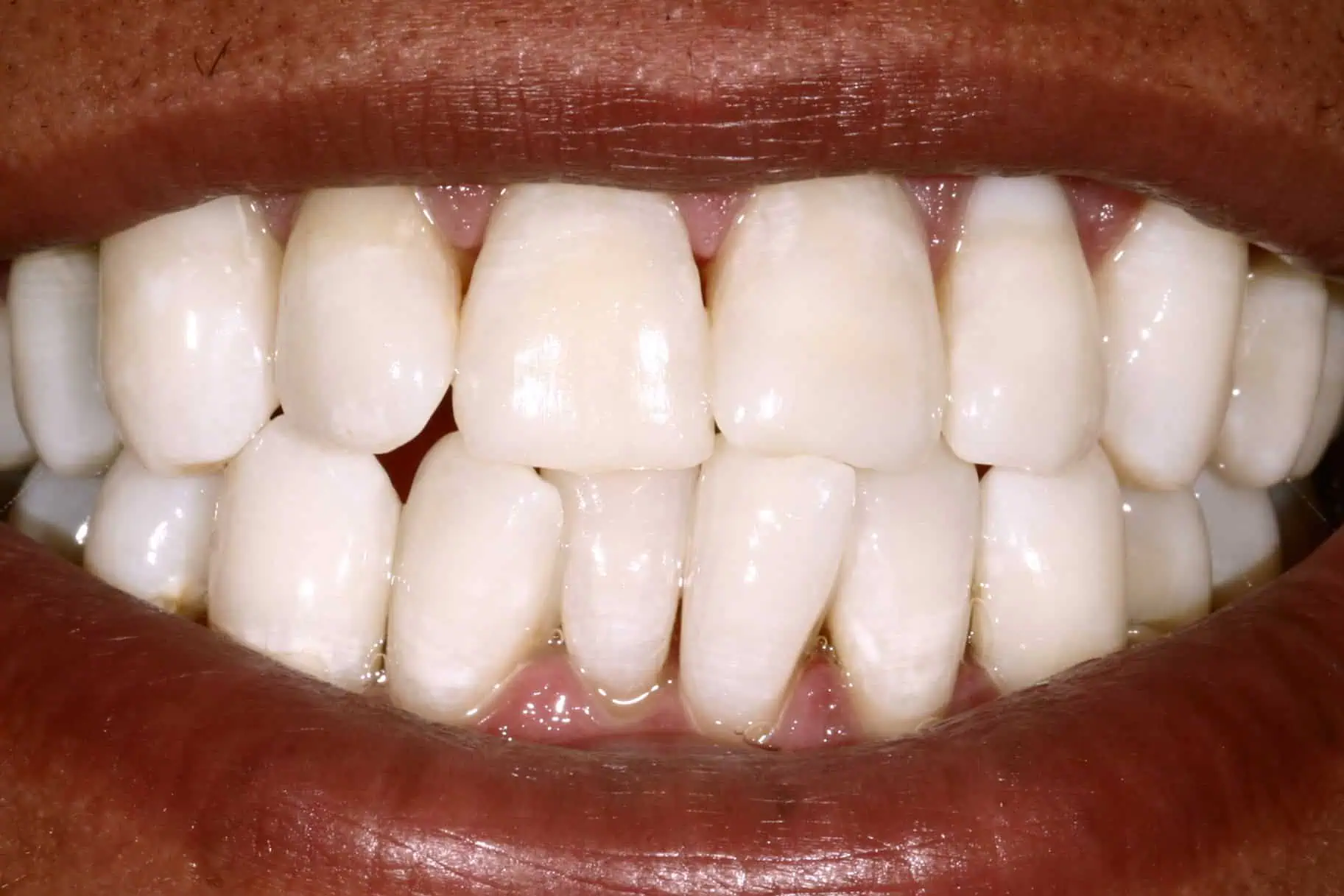 Close-up of teeth after treatment in Phoenix, AZ | 24th Street Dental Biltmore