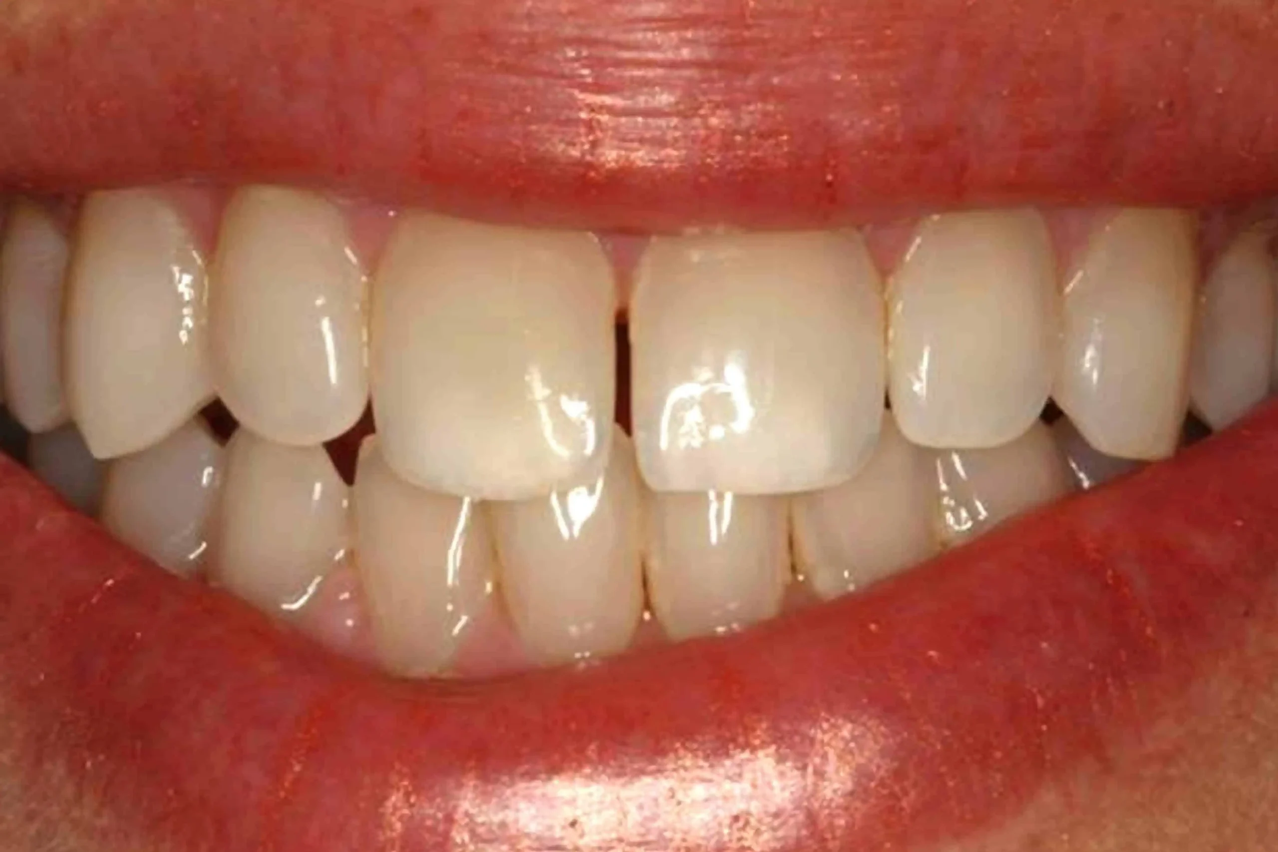 Close-up of teeth before treatment in Phoenix, AZ | 24th Street Dental Biltmore