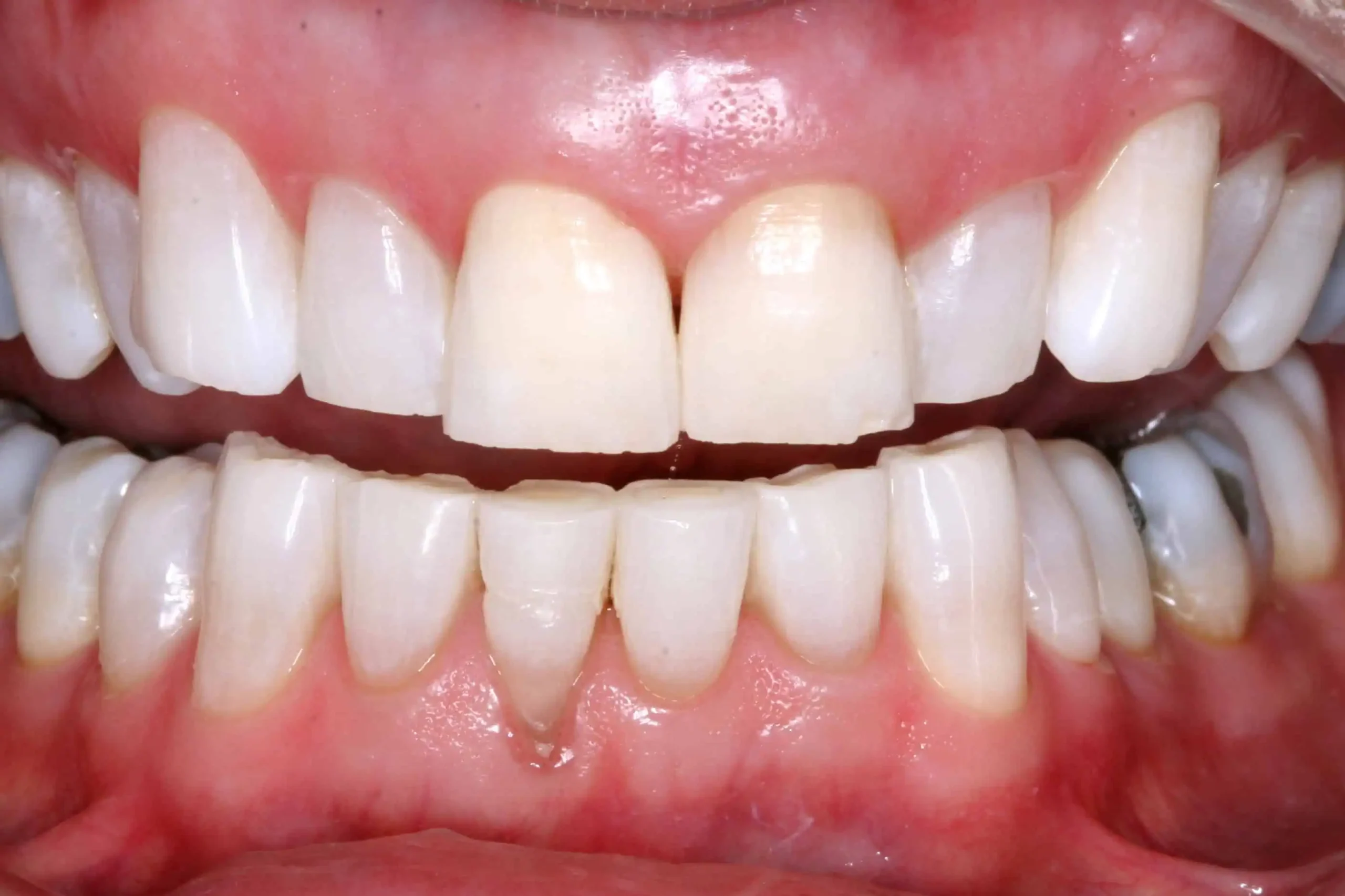 Close-up of teeth after treatment in Phoenix, AZ | 24th Street Dental Biltmore