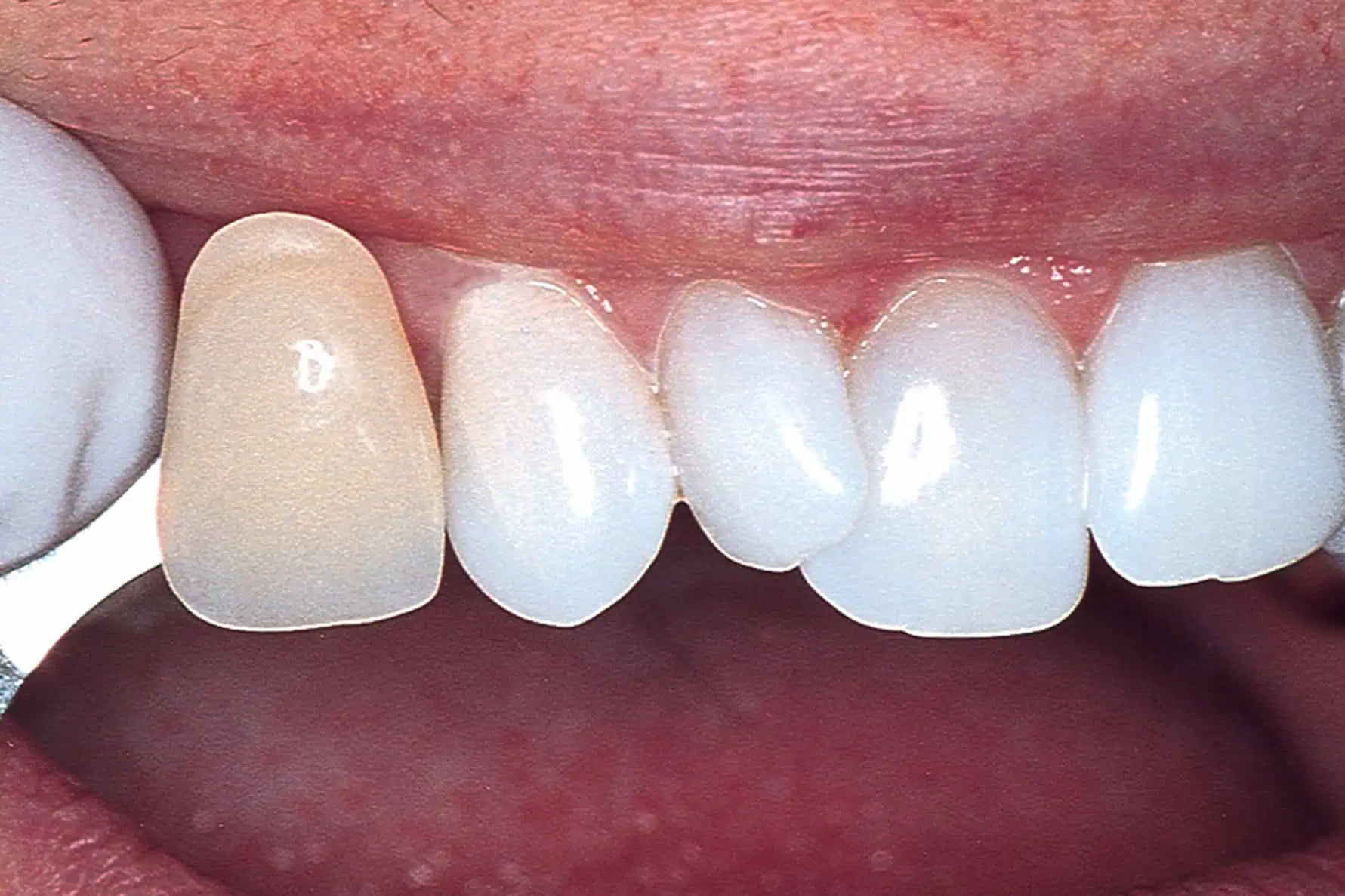 Tooth shade match after crown in Phoenix, AZ | 24th Street Dental Biltmore