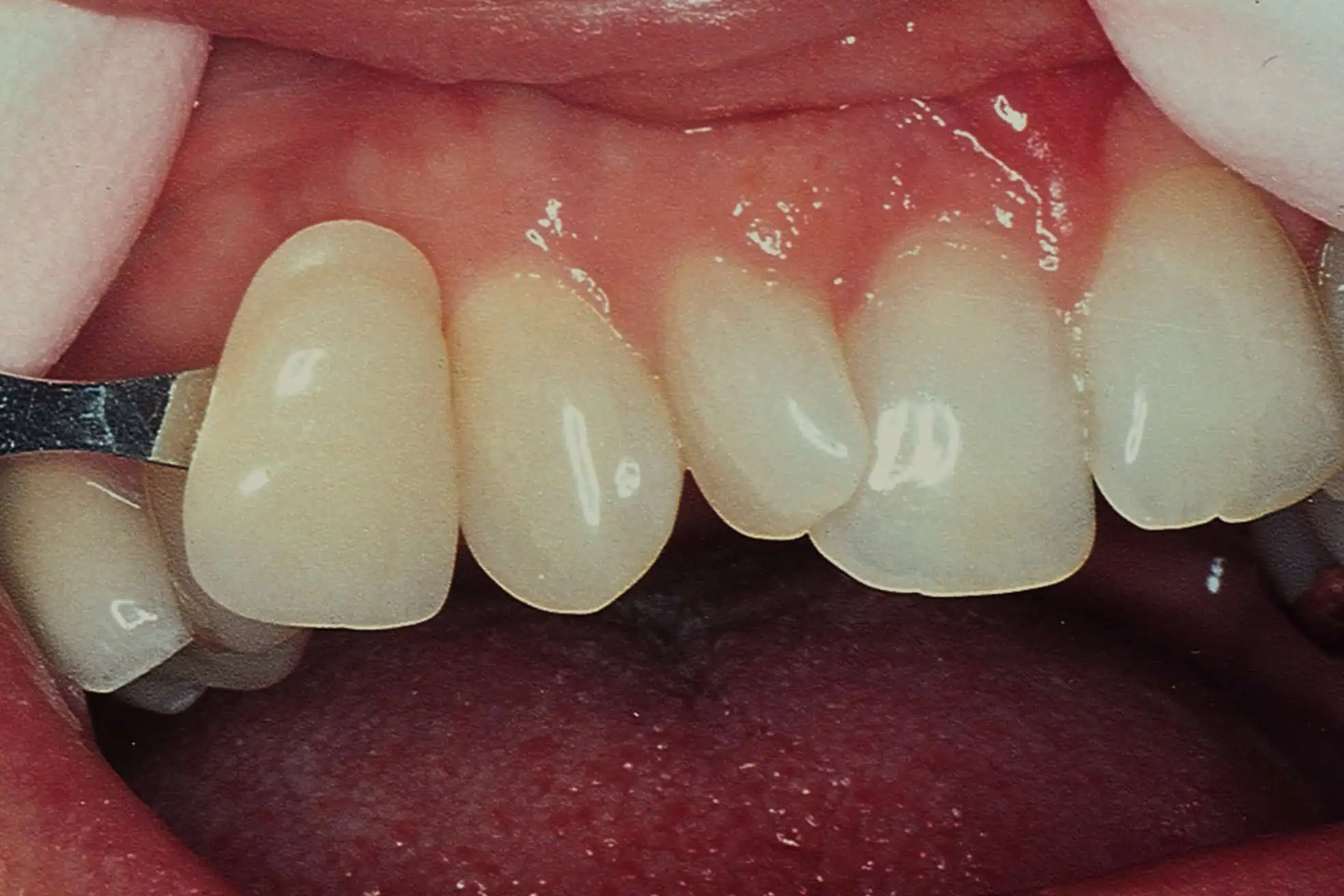 Tooth shade match before crown in Phoenix, AZ | 24th Street Dental Biltmore
