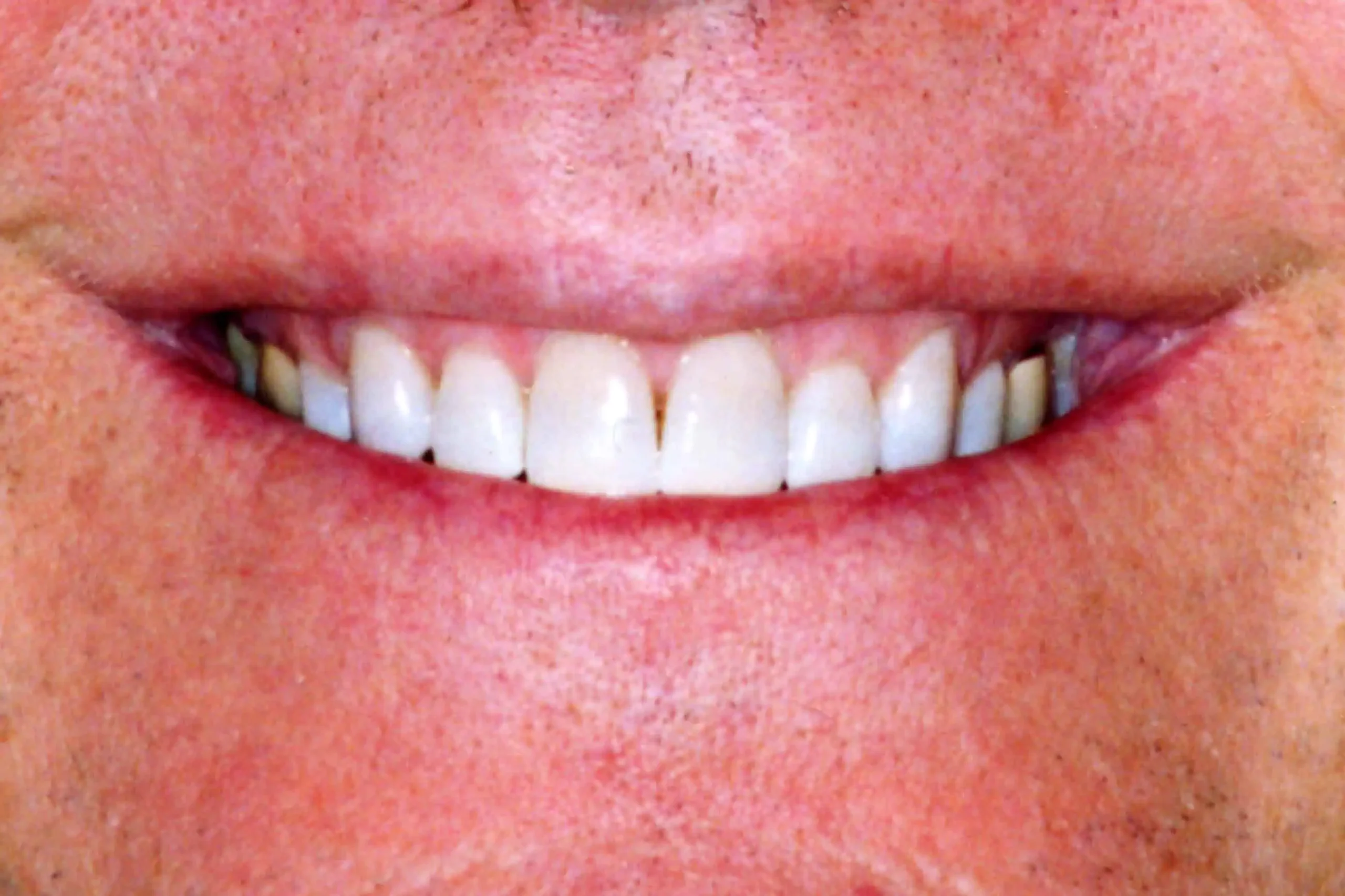 Close-up of teeth after treatment in Phoenix, AZ | 24th Street Dental Biltmore