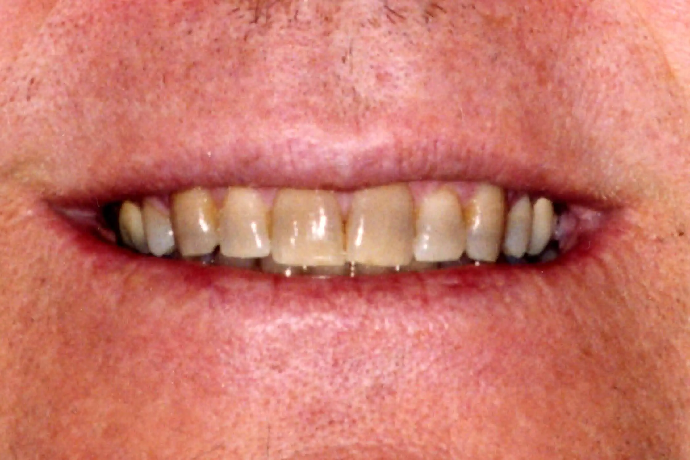 Close-up of teeth before treatment in Phoenix, AZ | 24th Street Dental Biltmore
