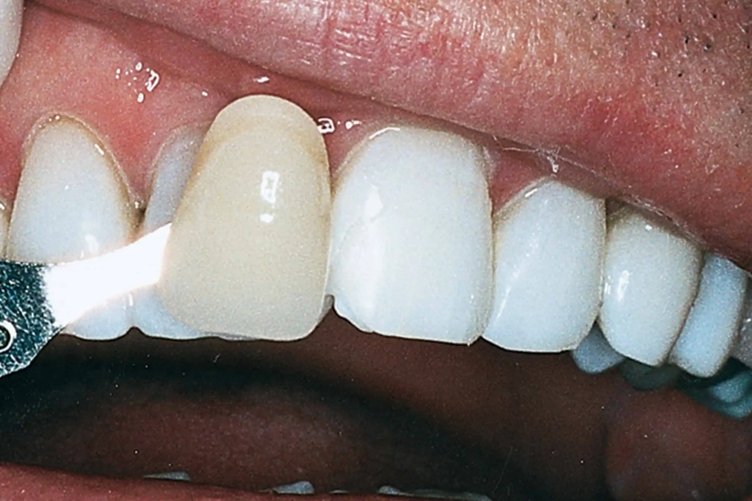 Tooth shade match after crown in Phoenix, AZ | 24th Street Dental Biltmore