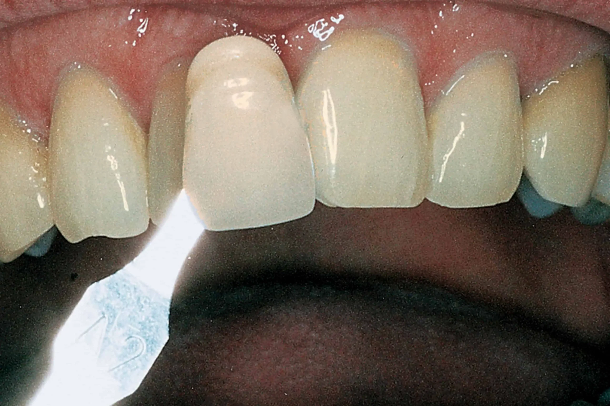 Tooth shade match before crown in Phoenix, AZ | 24th Street Dental Biltmore