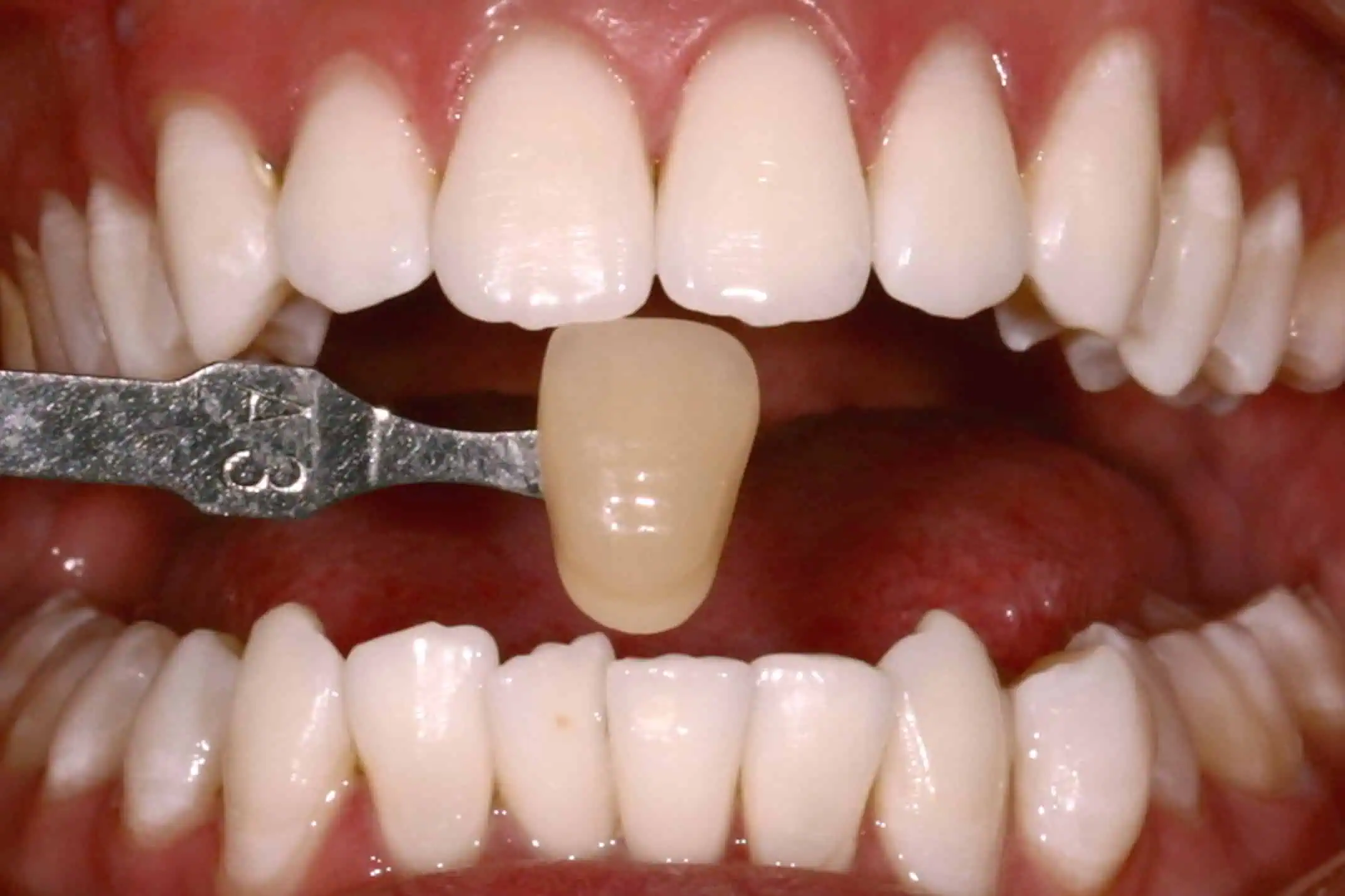 Tooth shade match after crown in Phoenix, AZ | 24th Street Dental Biltmore