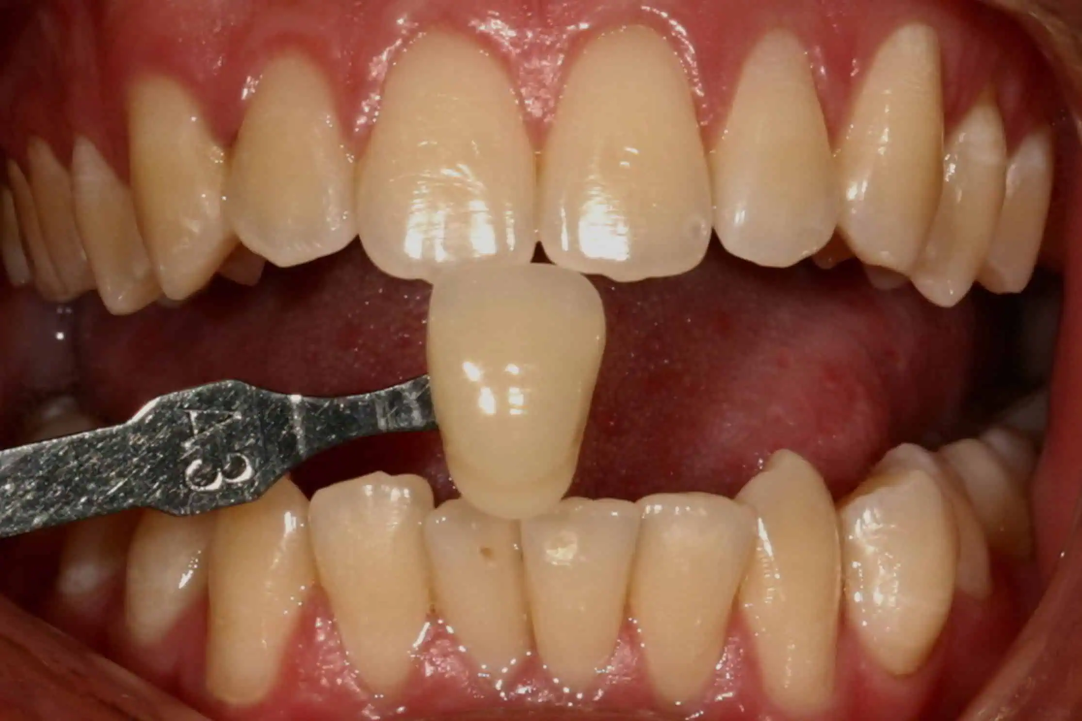 Tooth shade match before crown in Phoenix, AZ | 24th Street Dental Biltmore