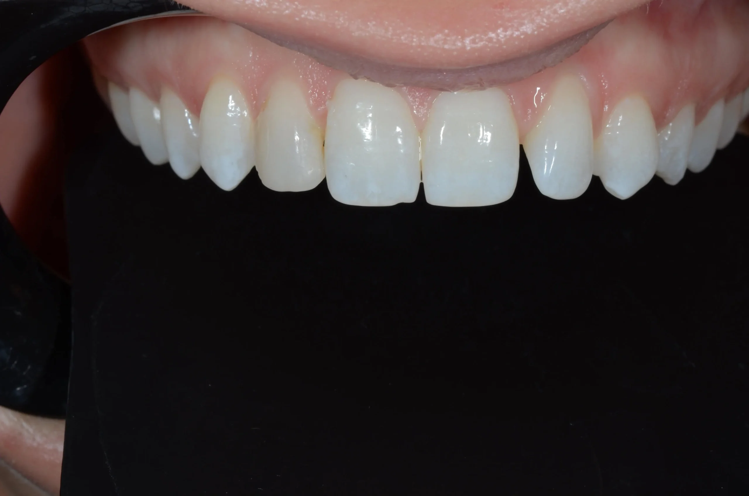 Dental veneers on upper front teeth in Phoenix, AZ | 24th Street Dental Biltmore