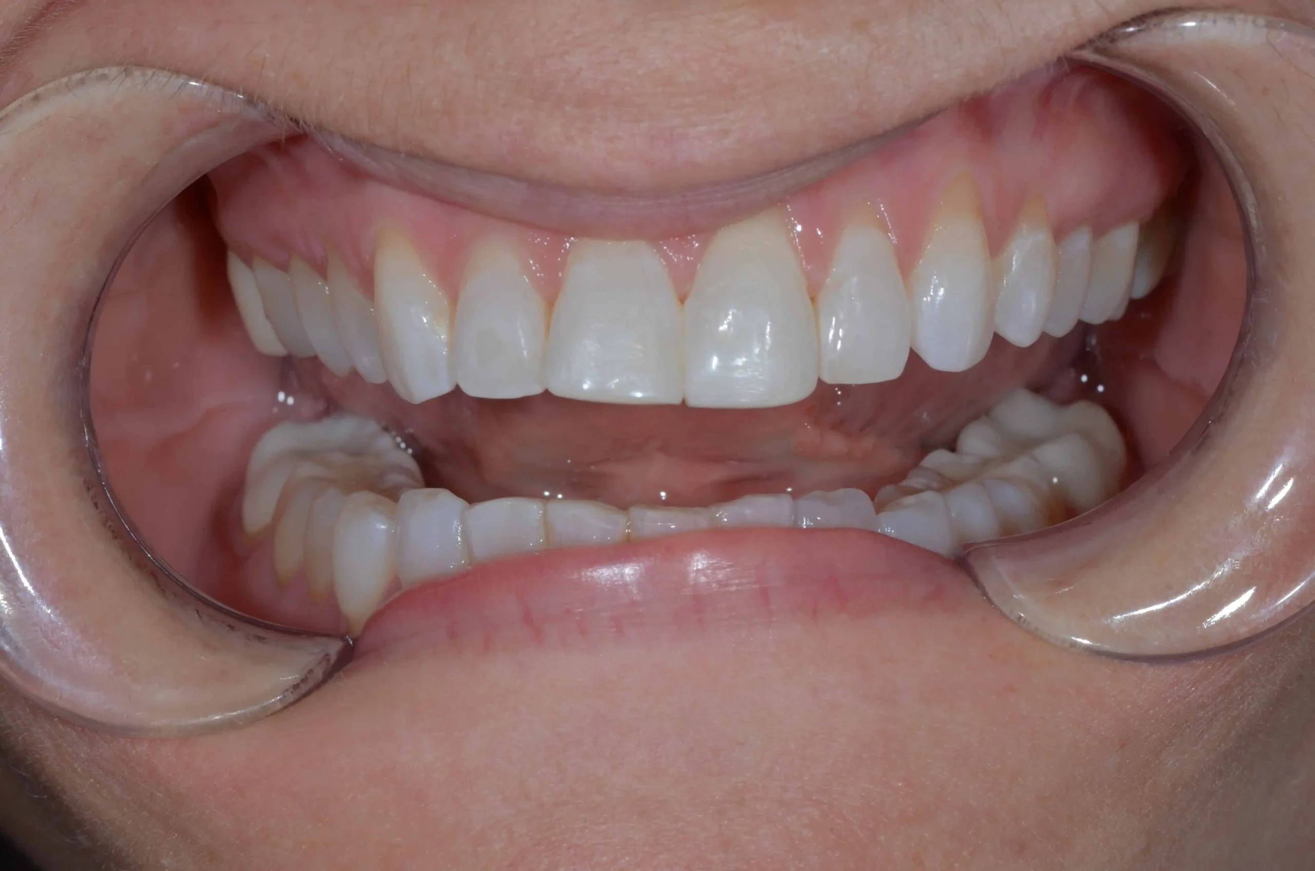 Teeth treatment images showcasing dental health improvement in Phoenix, AZ | 24th Street Dental Biltmore