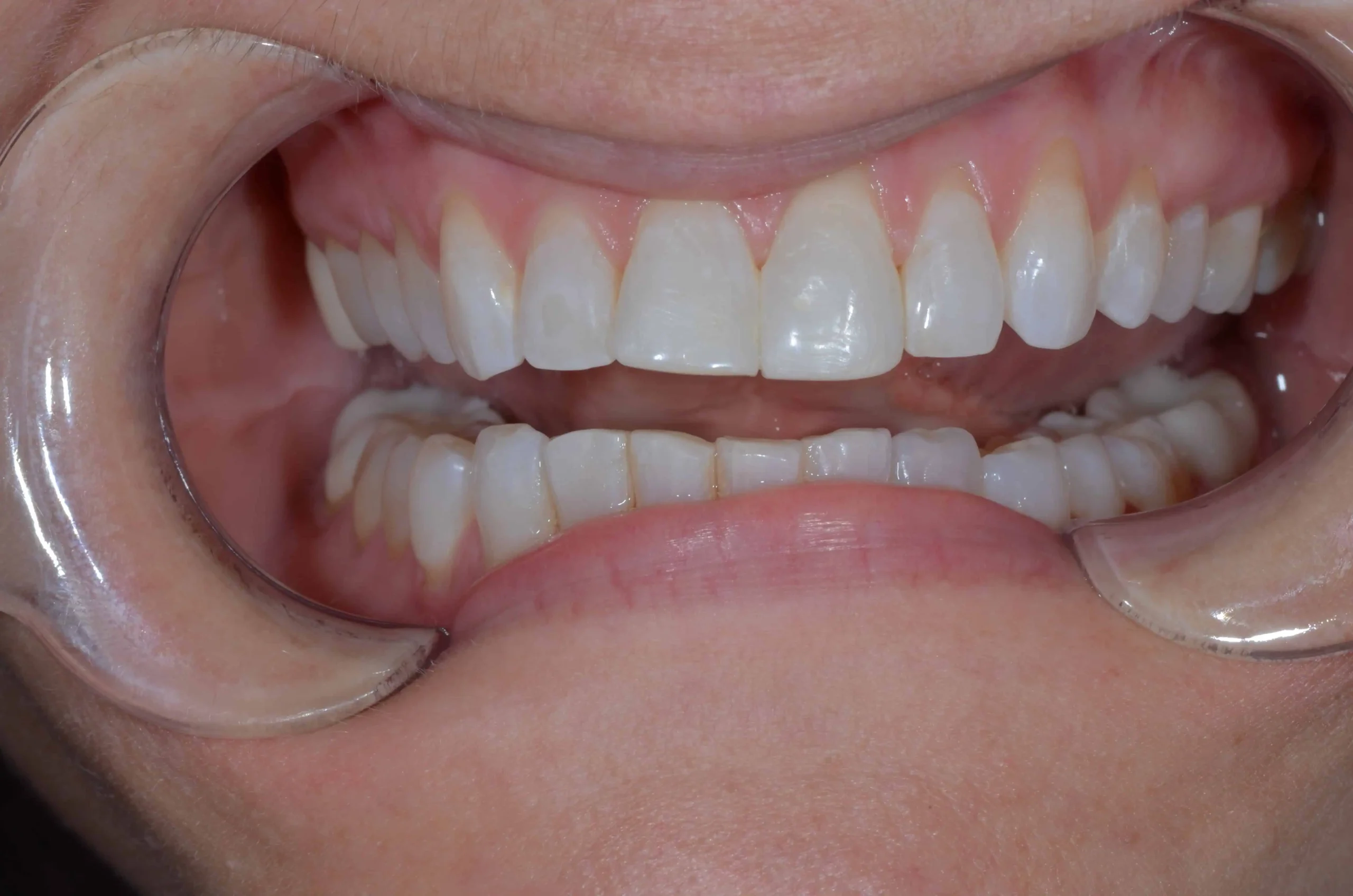 Teeth treatment images showcasing dental health improvement in Phoenix, AZ | 24th Street Dental Biltmore