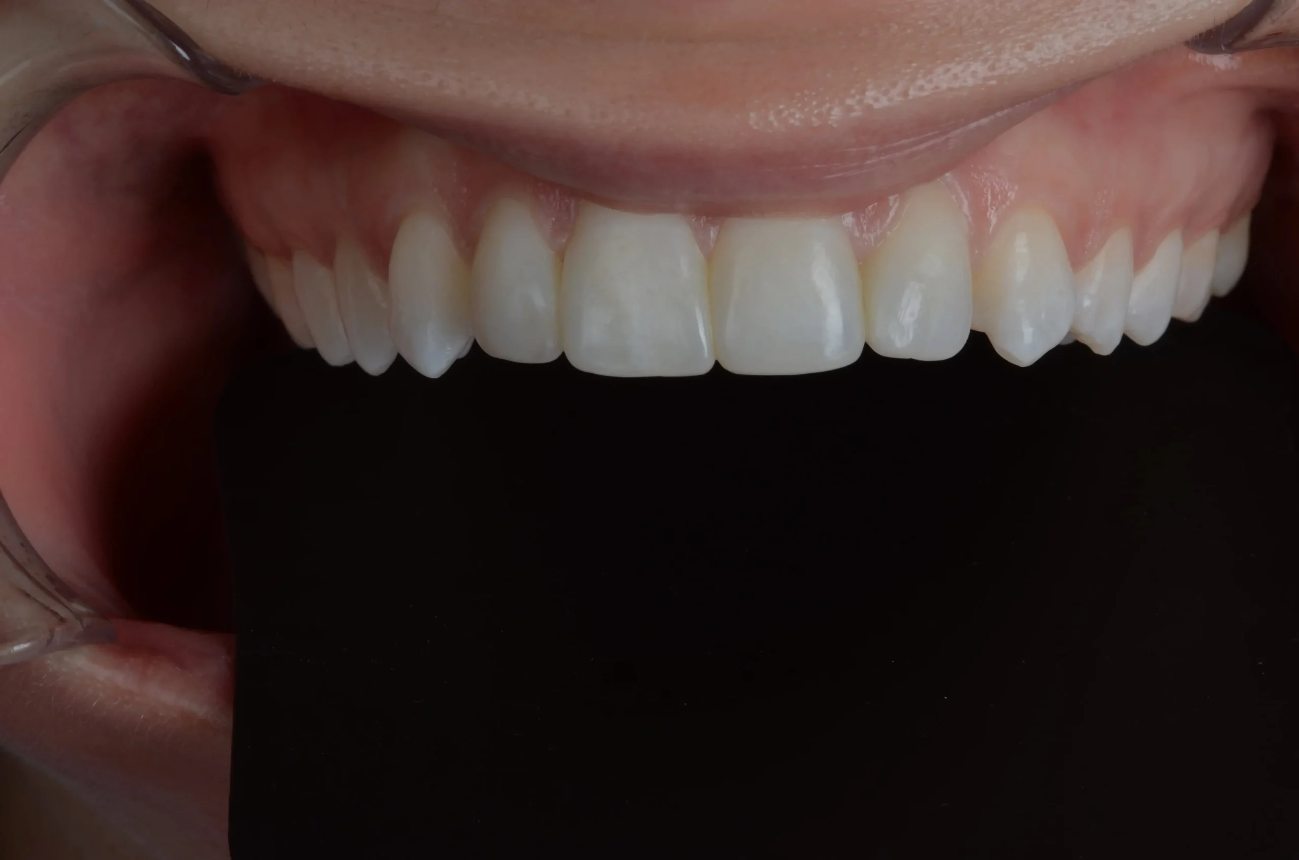 Close-up of white dental veneers in Phoenix, AZ | 24th Street Dental Biltmore