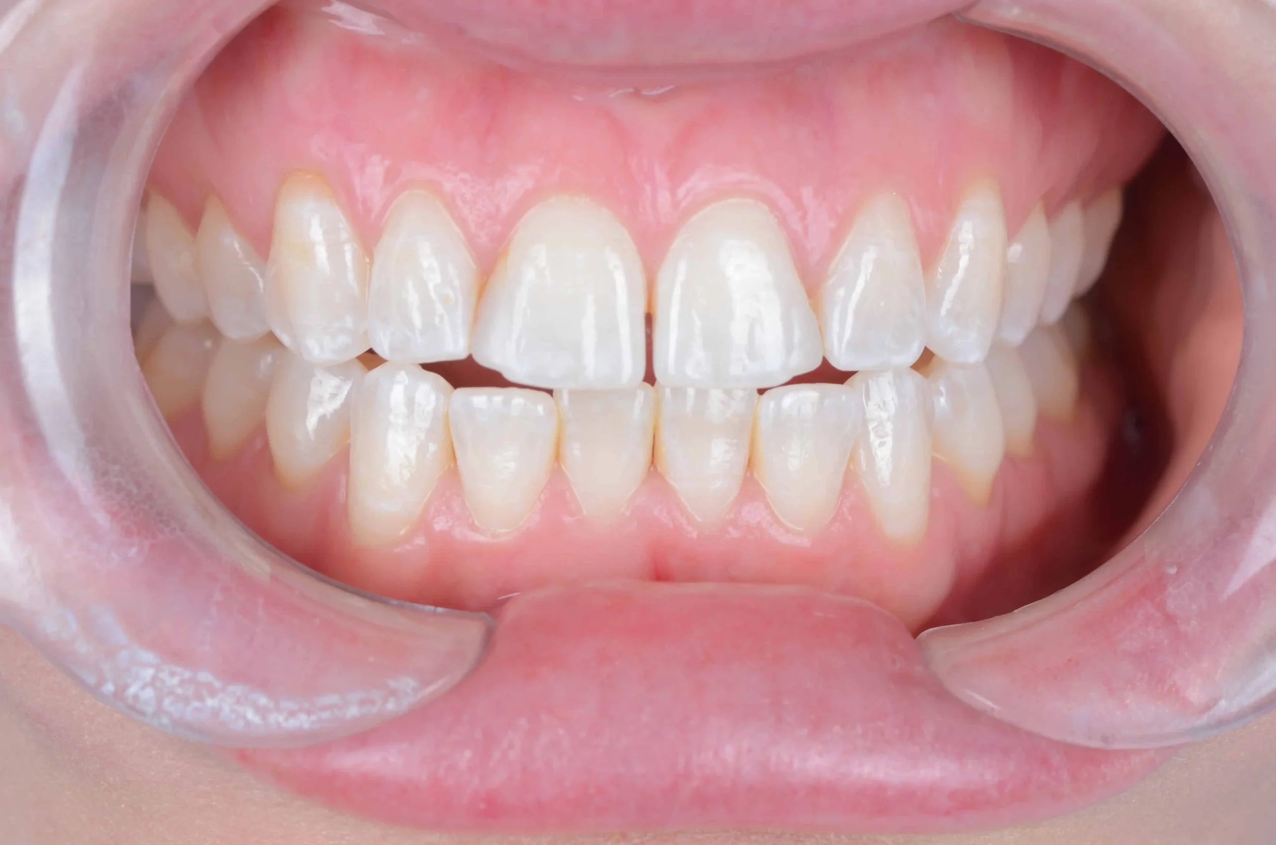 Teeth treatment images showcasing dental health improvement in Phoenix, AZ | 24th Street Dental Biltmore