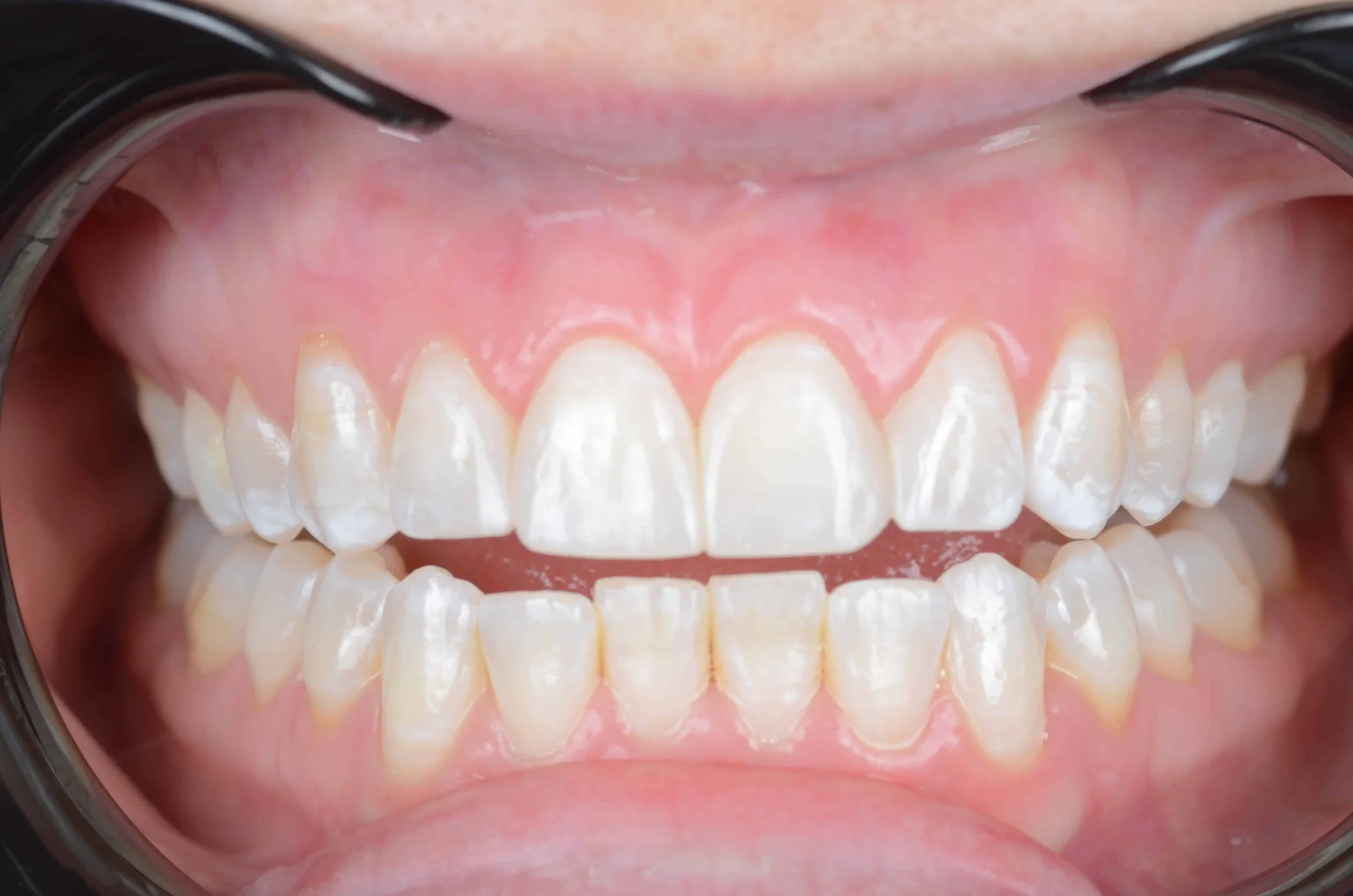 Teeth treatment images showcasing dental health improvement in Phoenix, AZ | 24th Street Dental Biltmore