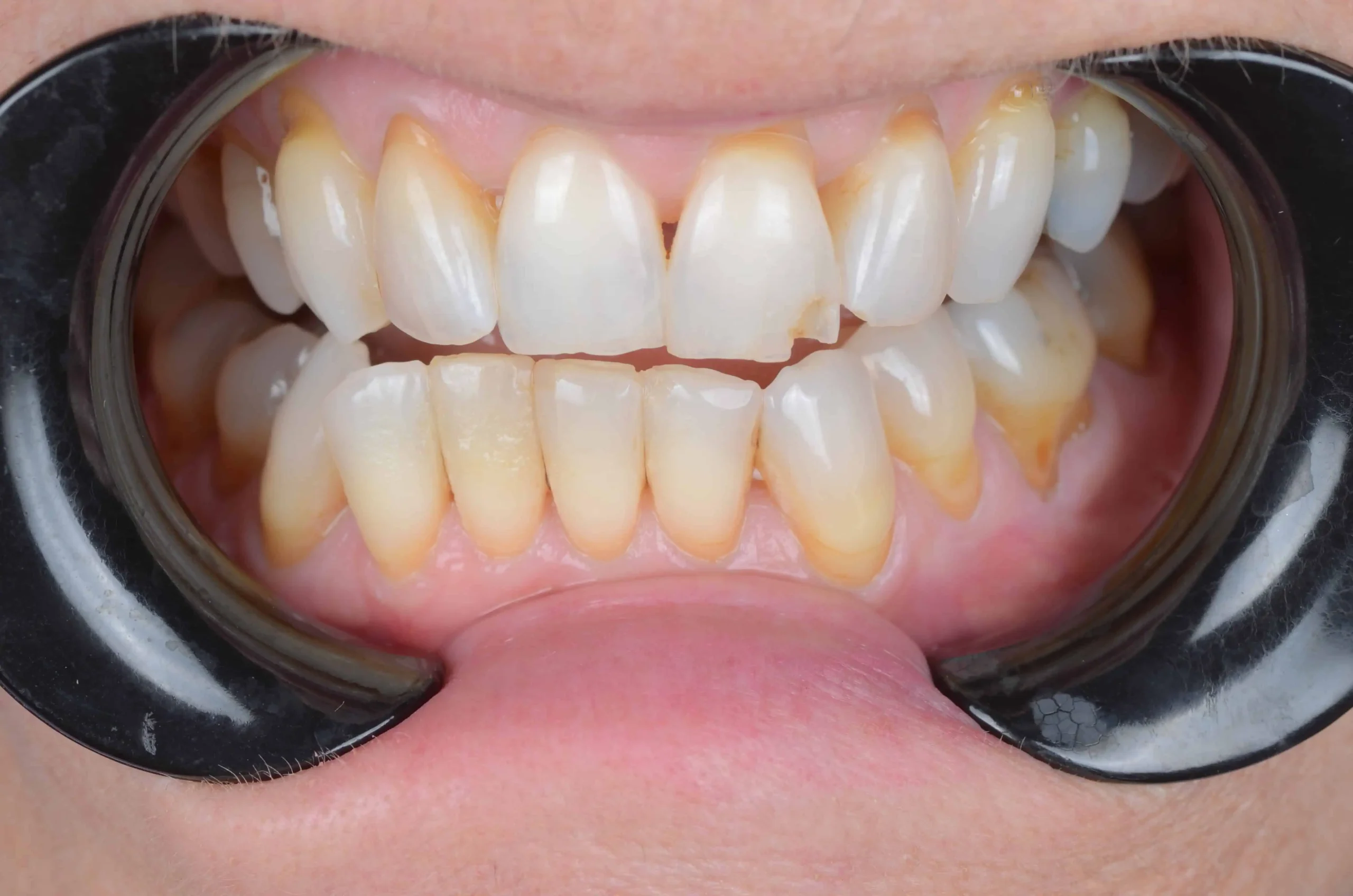 Teeth treatment images showcasing dental health improvement in Phoenix, AZ | 24th Street Dental Biltmore