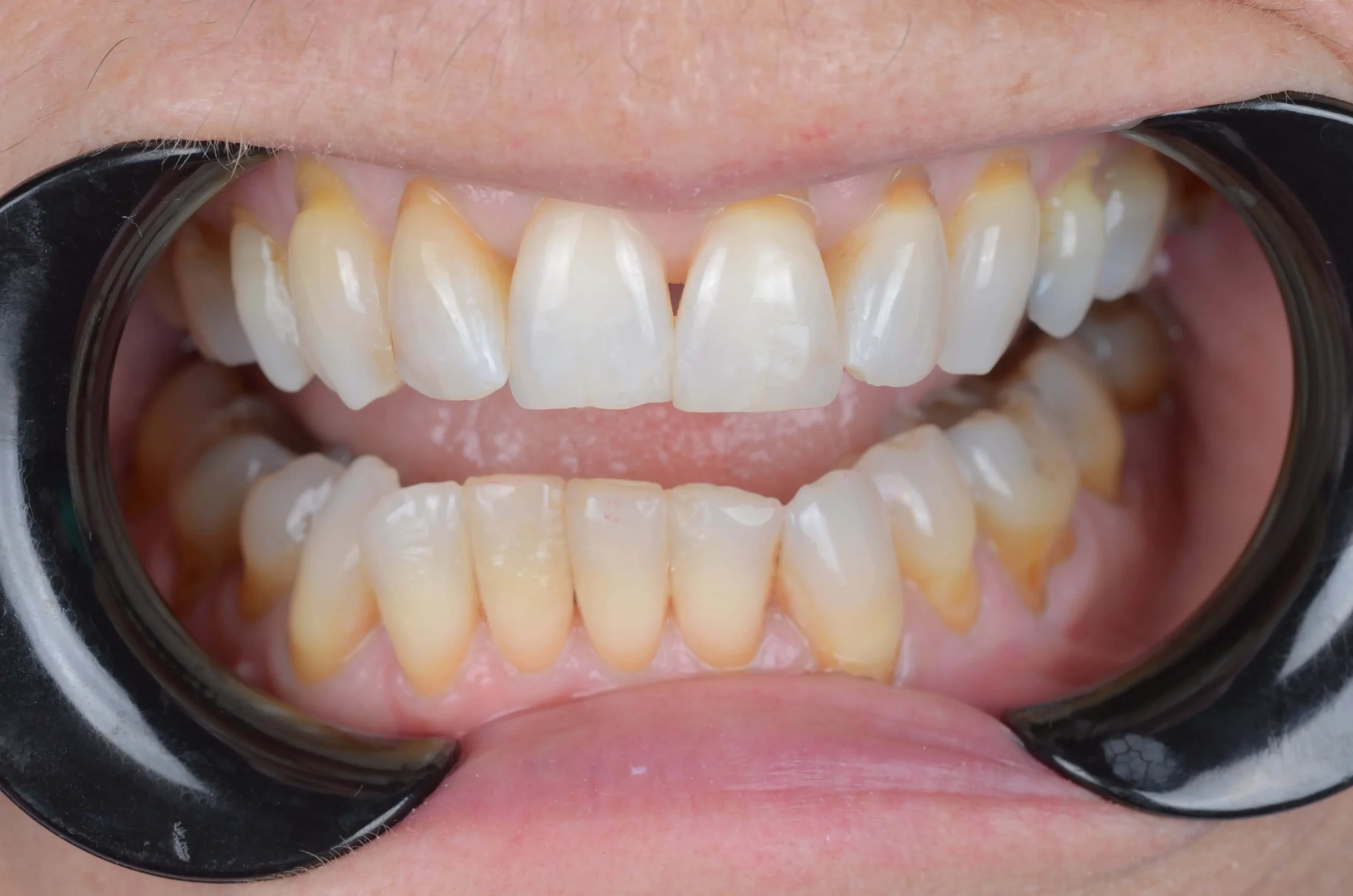 Teeth treatment images showcasing dental health improvement in Phoenix, AZ | 24th Street Dental Biltmore