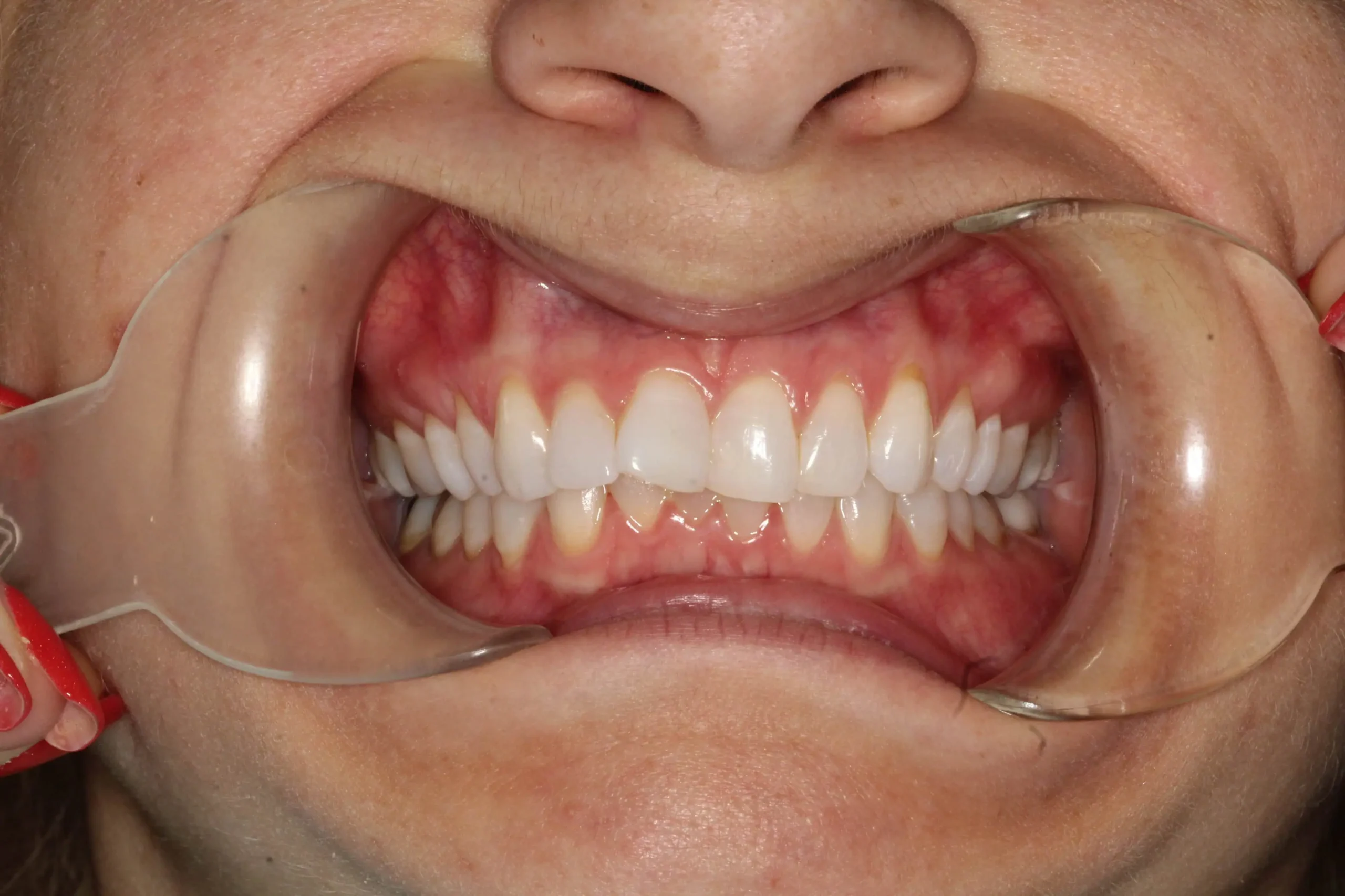 Close-up of teeth before treatment in Phoenix, AZ | 24th Street Dental Biltmore
