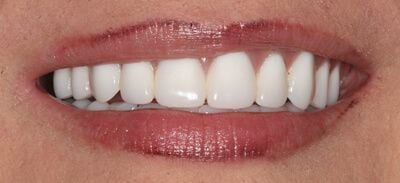 Close-up of teeth after treatment in Phoenix, AZ | 24th Street Dental Biltmore