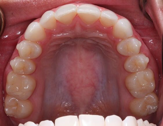 Close-up of teeth after treatment in Phoenix, AZ | 24th Street Dental Biltmore
