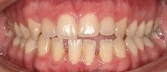 Close-up of teeth dental treatment in Phoenix, AZ | 24th Street Dental Biltmore