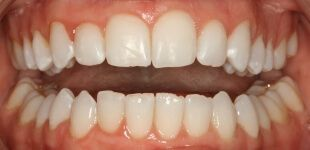 Close-up of teeth dental treatment in Phoenix, AZ | 24th Street Dental Biltmore