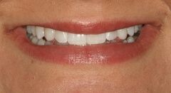 Close-up of teeth dental treatment in Phoenix, AZ | 24th Street Dental Biltmore