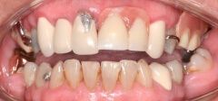 Close-up of teeth before treatment in Phoenix, AZ | 24th Street Dental Biltmore