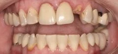 Close-up of teeth before treatment in Phoenix, AZ | 24th Street Dental Biltmore