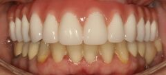 Close-up of teeth after treatment in Phoenix, AZ | 24th Street Dental Biltmore