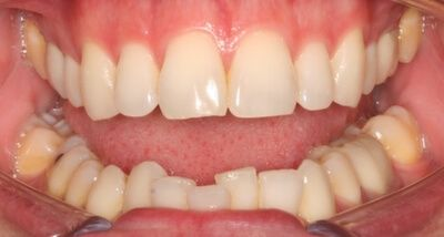 Close-up of teeth before treatment in Phoenix, AZ | 24th Street Dental Biltmore