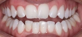 Close-up of teeth dental treatment in Phoenix, AZ | 24th Street Dental Biltmore