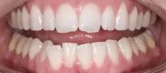 Close-up of teeth dental treatment in Phoenix, AZ | 24th Street Dental Biltmore