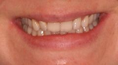 Close-up of teeth dental treatment in Phoenix, AZ | 24th Street Dental Biltmore