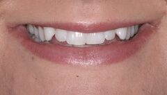 Close-up of teeth dental treatment in Phoenix, AZ | 24th Street Dental Biltmore