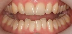 Close-up of teeth before treatment in Phoenix, AZ | 24th Street Dental Biltmore