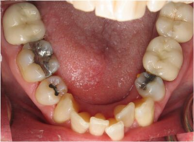 Close-up of teeth dental treatment in Phoenix, AZ | 24th Street Dental Biltmore