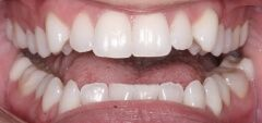 Close-up of teeth dental treatment in Phoenix, AZ | 24th Street Dental Biltmore