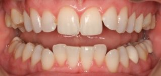 Close-up of teeth before treatment in Phoenix, AZ | 24th Street Dental Biltmore